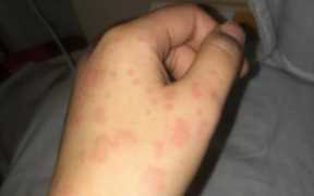 荨麻疹会不会传染给别人（荨麻疹会不会传染）