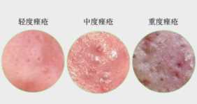 痤疮治不好，全因没有对症！痤疮分5类，治疗前先辨别你是哪种？
