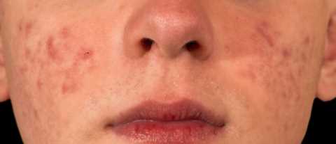 痤疮治不好，全因没有对症！痤疮分5类，治疗前先辨别你是哪种？