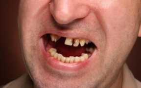 牙科价目收费表（牙齿补个洞大概多少钱）