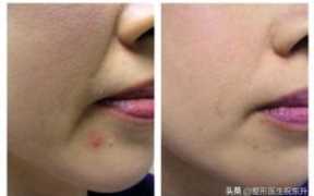 如何缓解法令纹的出现(青少年法令纹怎么消除)