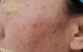 放血疗法治疗青春痘，面部痘痘放血疗法