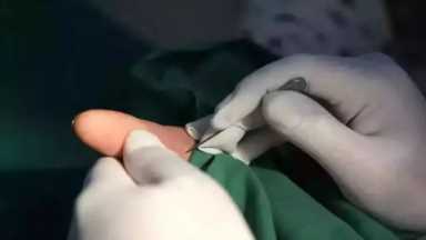 神奇的“小针刀”，到底是针还是刀？