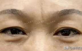 上眼睑下垂恢复锻炼法，眼睑下垂锻炼方法