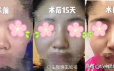 肥厚鼻尖矫正术，鼻头大缩小手术过程