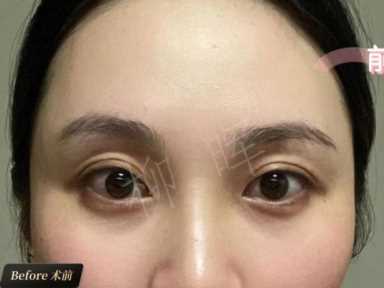 眼窝凹陷面露凶相？打了玻尿酸，眼睛好看，亲和力满满！