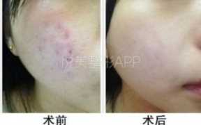 黑脸娃娃祛痘效果如何，黑脸娃娃祛痘效果