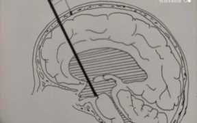 脑积水治疗，脑积水最佳处理方法