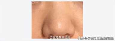 隆鼻案例：肉鼻头、宽鼻翼缩窄做自体肋骨鼻综合1个月，年轻10岁