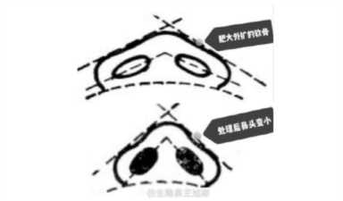 隆鼻案例：肉鼻头、宽鼻翼缩窄做自体肋骨鼻综合1个月，年轻10岁