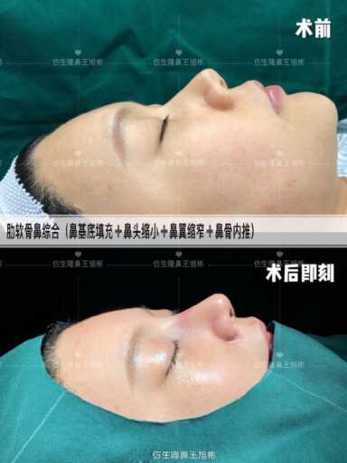 隆鼻案例：肉鼻头、宽鼻翼缩窄做自体肋骨鼻综合1个月，年轻10岁