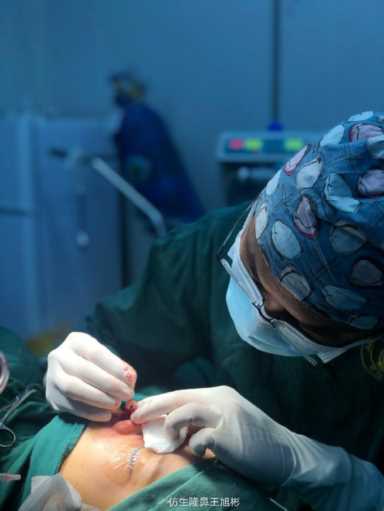 隆鼻案例：肉鼻头、宽鼻翼缩窄做自体肋骨鼻综合1个月，年轻10岁