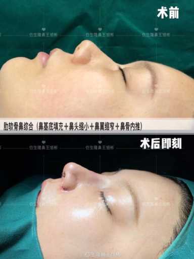 隆鼻案例：肉鼻头、宽鼻翼缩窄做自体肋骨鼻综合1个月，年轻10岁