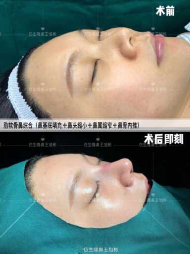 隆鼻案例：肉鼻头、宽鼻翼缩窄做自体肋骨鼻综合1个月，年轻10岁