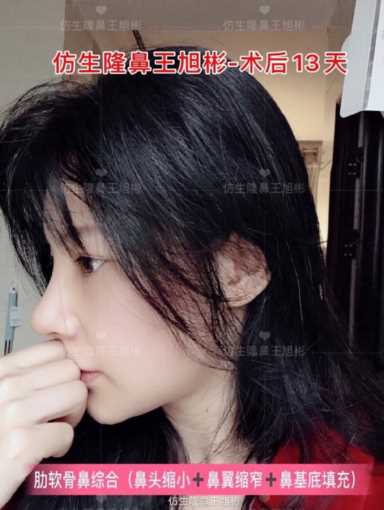 隆鼻案例：肉鼻头、宽鼻翼缩窄做自体肋骨鼻综合1个月，年轻10岁