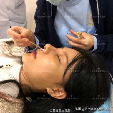 隆鼻案例：肉鼻头、宽鼻翼缩窄做自体肋骨鼻综合1个月，年轻10岁