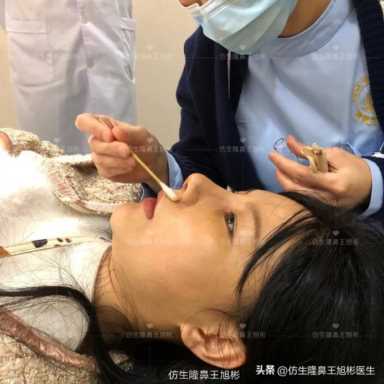 隆鼻案例：肉鼻头、宽鼻翼缩窄做自体肋骨鼻综合1个月，年轻10岁