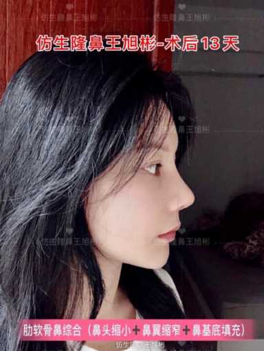 隆鼻案例：肉鼻头、宽鼻翼缩窄做自体肋骨鼻综合1个月，年轻10岁