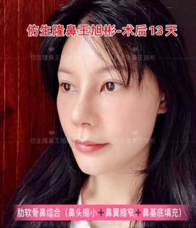 隆鼻案例：肉鼻头、宽鼻翼缩窄做自体肋骨鼻综合1个月，年轻10岁