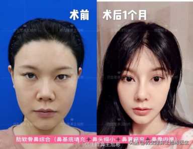 隆鼻案例：肉鼻头、宽鼻翼缩窄做自体肋骨鼻综合1个月，年轻10岁