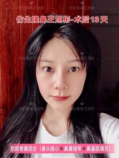 隆鼻案例：肉鼻头、宽鼻翼缩窄做自体肋骨鼻综合1个月，年轻10岁