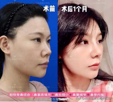 隆鼻案例：肉鼻头、宽鼻翼缩窄做自体肋骨鼻综合1个月，年轻10岁