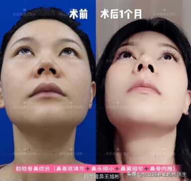 隆鼻案例：肉鼻头、宽鼻翼缩窄做自体肋骨鼻综合1个月，年轻10岁