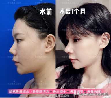 隆鼻案例：肉鼻头、宽鼻翼缩窄做自体肋骨鼻综合1个月，年轻10岁