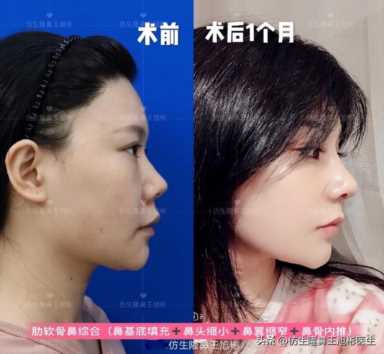 隆鼻案例：肉鼻头、宽鼻翼缩窄做自体肋骨鼻综合1个月，年轻10岁