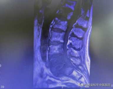 小针刀：小身材 却有大作用