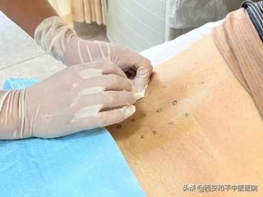 小针刀：小身材 却有大作用