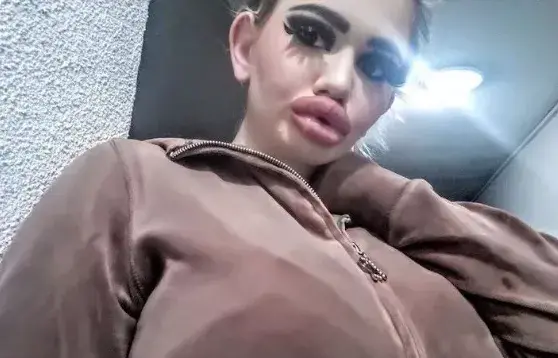 20次丰唇手术，她把自己整成了“世界上嘴唇最厚”的真人芭比