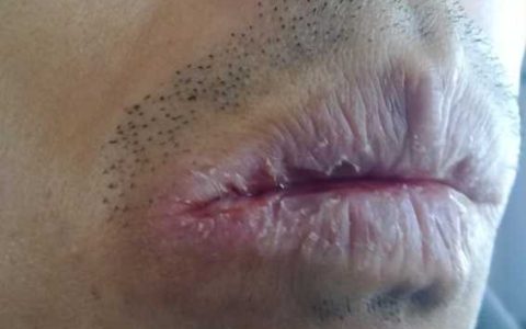 口干舌燥吃什么，口干舌燥吃什么药最好中成药