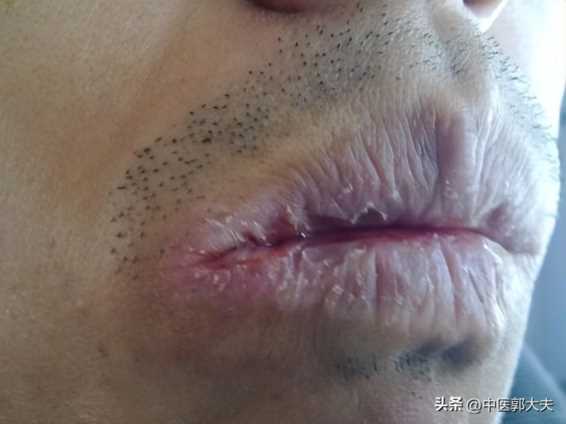 口干舌燥吃什么，口干舌燥吃什么药最好中成药