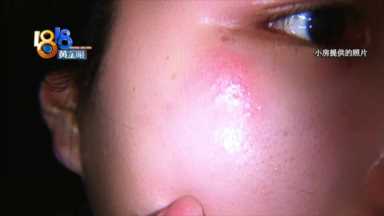 “果酸焕肤”又红又肿，老公都不跟自己说话了