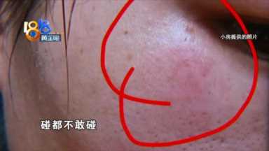 “果酸焕肤”又红又肿，老公都不跟自己说话了