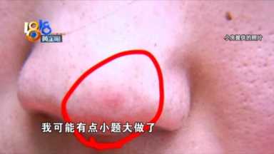 “果酸焕肤”又红又肿，老公都不跟自己说话了