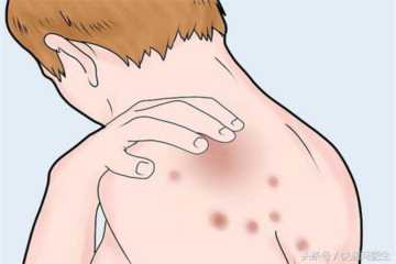 传染性湿疹样皮炎,痒的皮肤病插图5 痒,痒,痒!这个皮肤病你不注意!反复发作要人命!