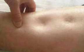 肾内科的病人,肾内科常见疾病及护理