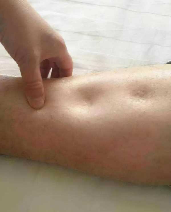 肾内科的病人,肾内科常见疾病及护理