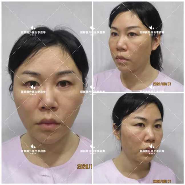 脸太长怎么整容好看,脸长怎么整形