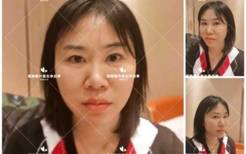 脸太长怎么整容好看,脸长怎么整形