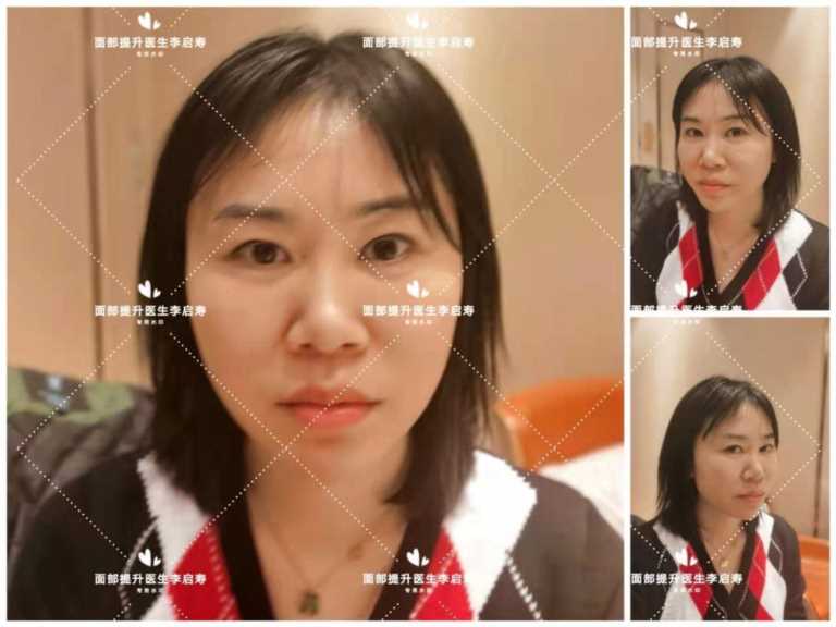 脸太长怎么整容好看,脸长怎么整形