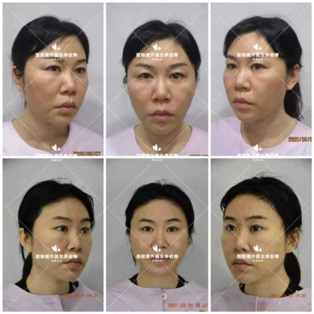 脸太长怎么整容好看,脸长怎么整形