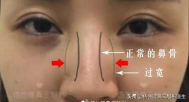 科学变美｜怎么提高正脸颜值，鼻骨内推必须了解