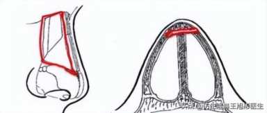 科学变美｜怎么提高正脸颜值，鼻骨内推必须了解