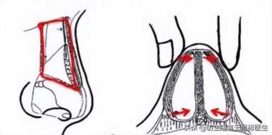 科学变美｜怎么提高正脸颜值，鼻骨内推必须了解