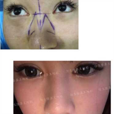 科学变美｜怎么提高正脸颜值，鼻骨内推必须了解