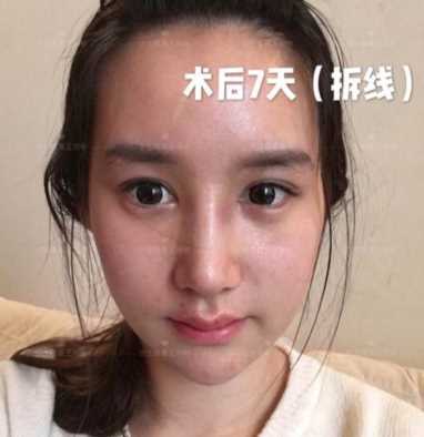 科学变美｜怎么提高正脸颜值，鼻骨内推必须了解