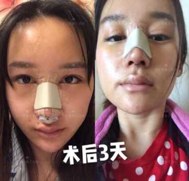 科学变美｜怎么提高正脸颜值，鼻骨内推必须了解